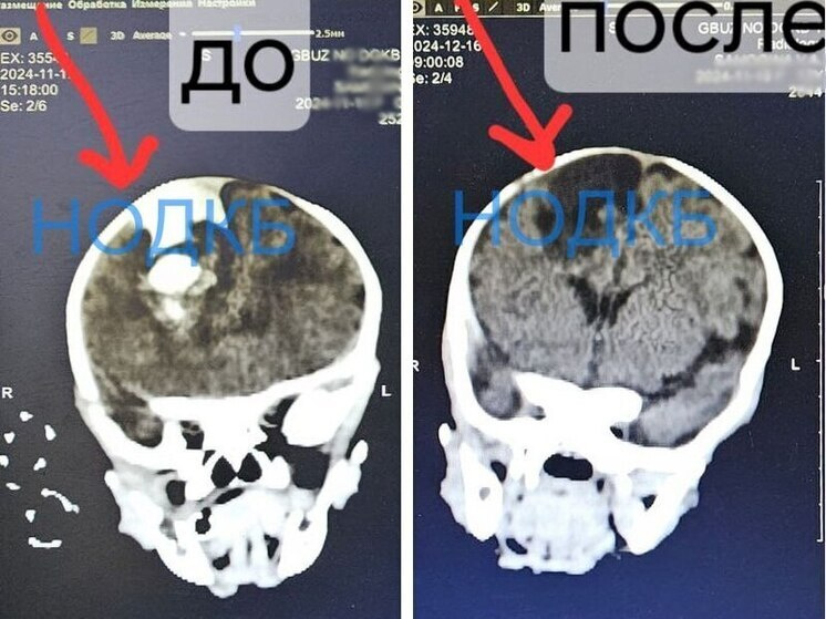 Младенца с кровоизлиянием в мозг спасли нижегородские нейрохирурги